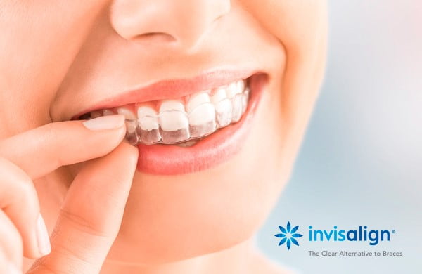 Glassline: O alinhador invisível da OrthoDontic - Blog - OrthoDontic Sorria  Sempre