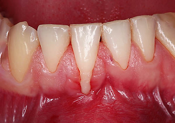 Cirurgia de Recobrimento Radicular para Recessão Gengival