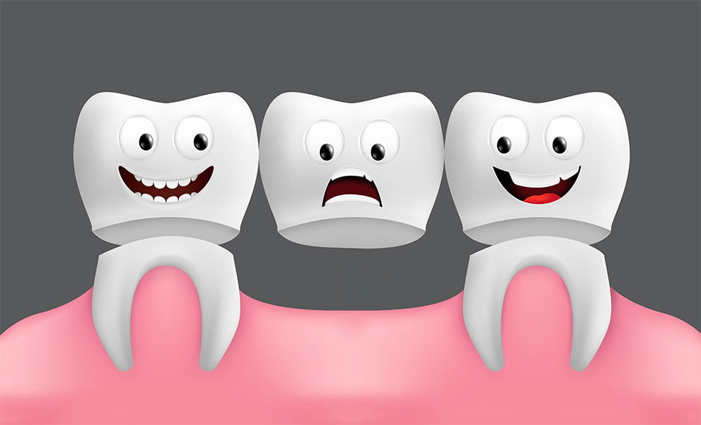 Ponte Fixa vs IMplante dentário
