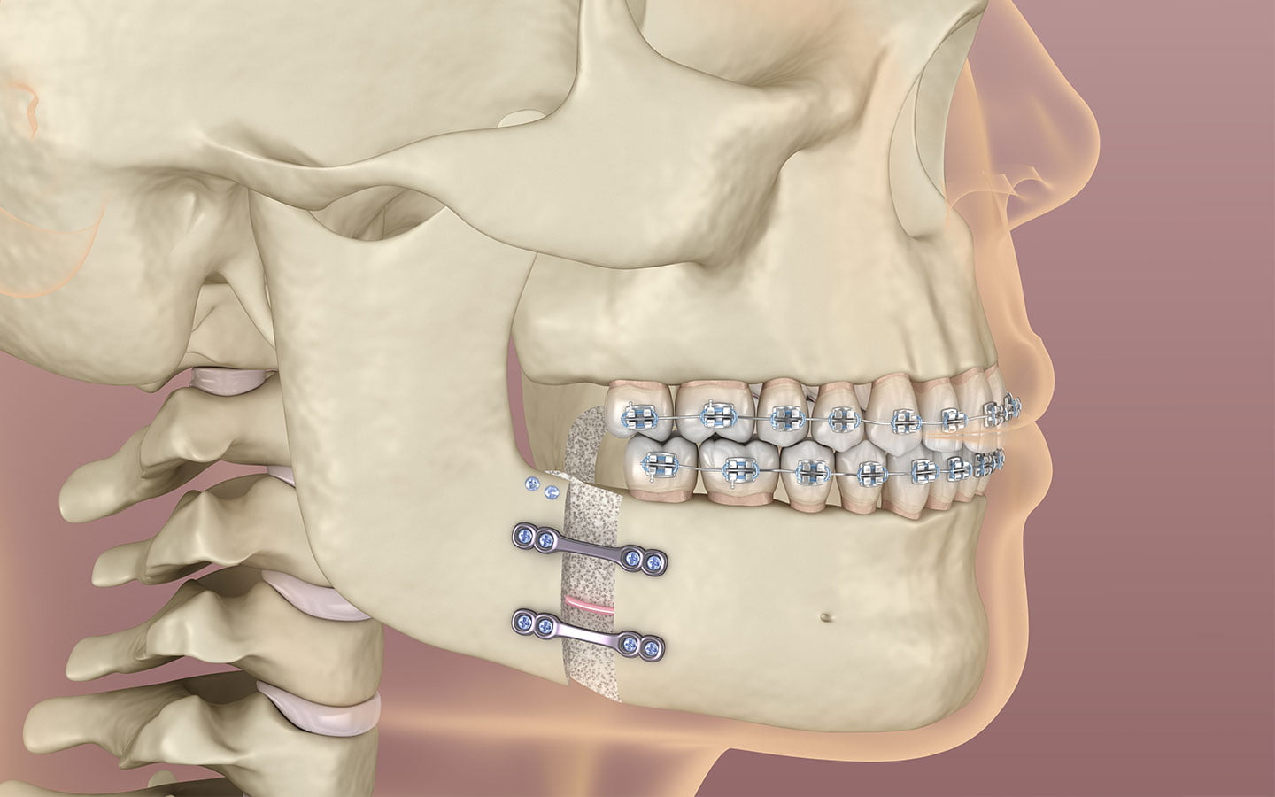 Prognatismo mandibular