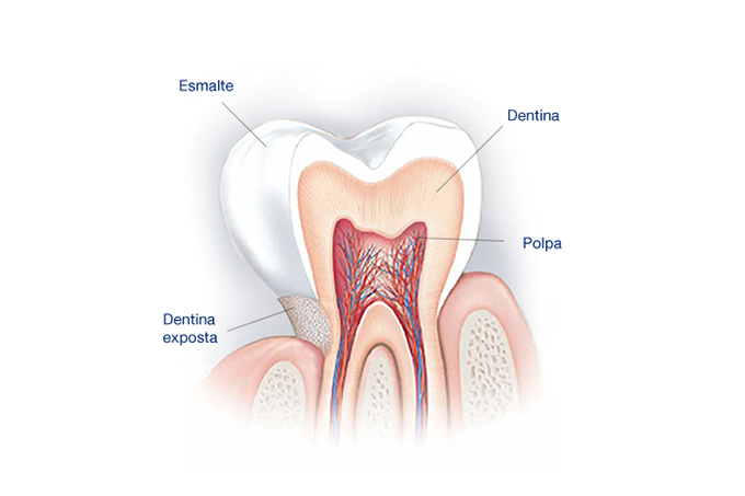 Estrutura de um dente: dentina exposta é caminho aberto para a hipersensibilidade dentinária 