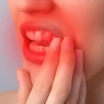 Gengivoestomatite Herpética