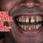Doença Periodontal ou Piorréia: causas e tratamentos