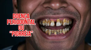 Doença Periodontal ou Piorréia: causas e tratamentos