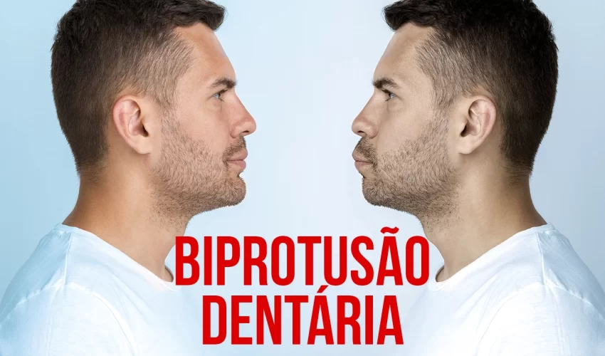 IMG BIPROTUSAO DENTARIA CAUSAS E TRATAMENTO