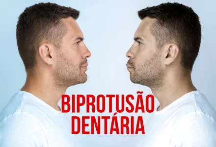 IMG BIPROTUSAO DENTARIA CAUSAS E TRATAMENTO