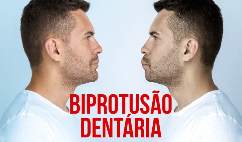IMG BIPROTUSAO DENTARIA CAUSAS E TRATAMENTO