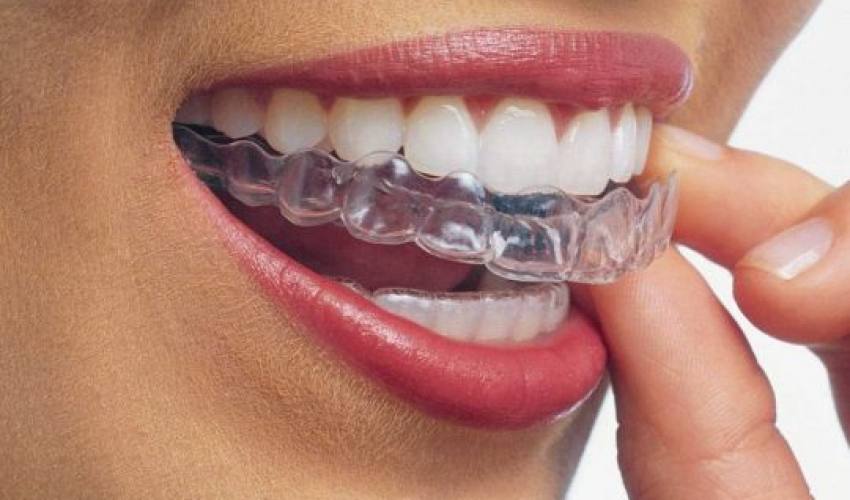 img-Invisalign-especialista-certificado