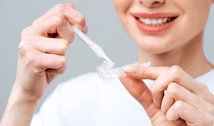 Clareamento dental Caseiro funciona?