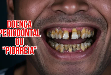 Doença Periodontal ou Piorréia: causas e tratamentos