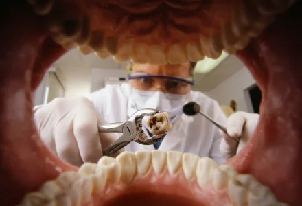 Extração de Dente: quando fazer e quanto custa