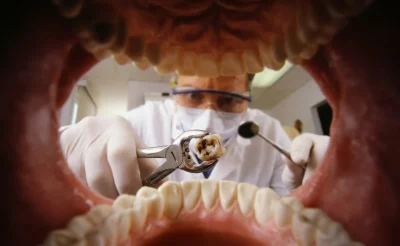 Extração de Dente: quando fazer e quanto custa
