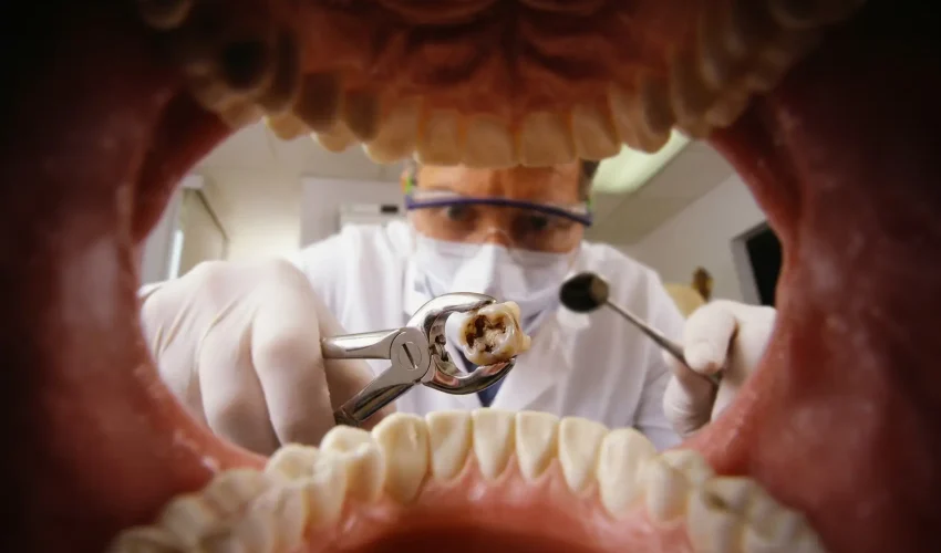 Extração de Dente: quando fazer e quanto custa