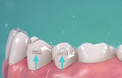 img-funcionamento-Invisalign-e-Attachments img-funcionamento-Invisalign-e-Attachments