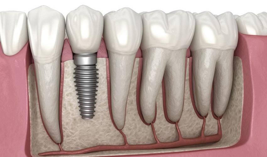 img-ilustracao-implantes-dentais
