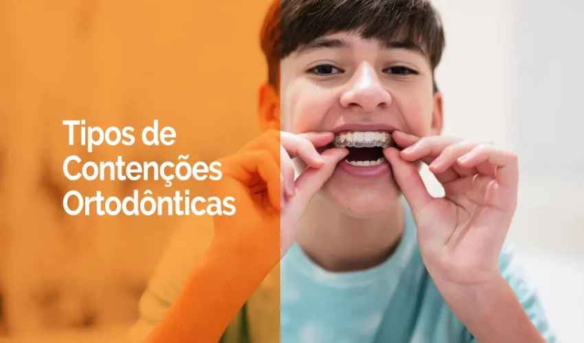 tipos de aparelhos de contenção