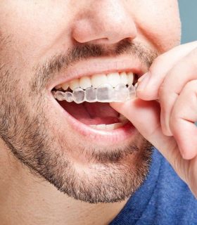 Aparelho Invisalign