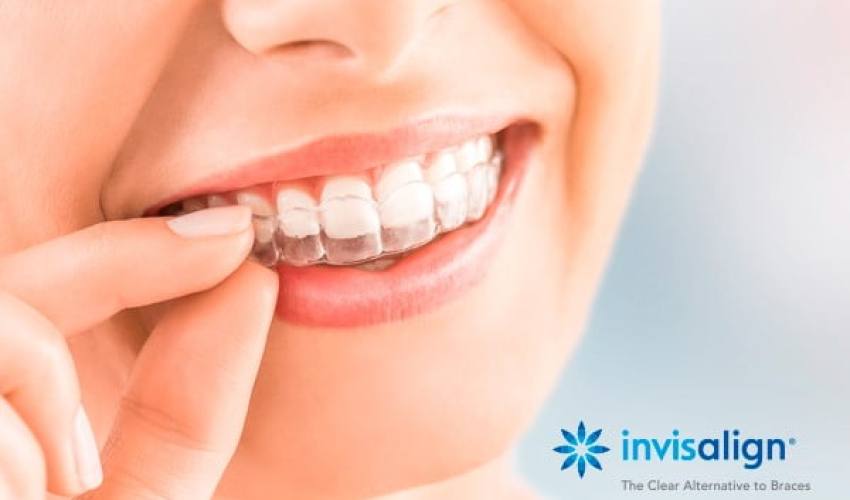 Qual a diferença entre Invisalign e outros Alinhadores Invisíveis?